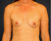 Feel Beautiful - Breast Augmentation 160 - Before Photo